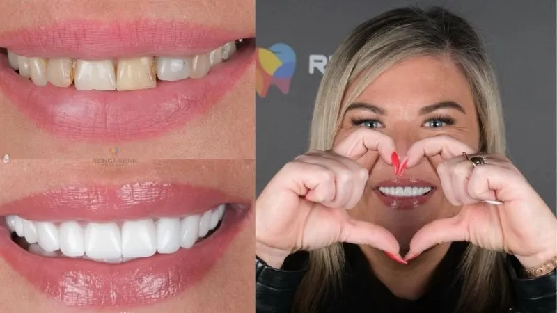 How long do veneers last