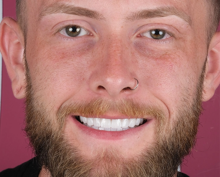 Veneers before and after