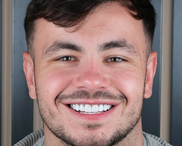 Dental implants before and after