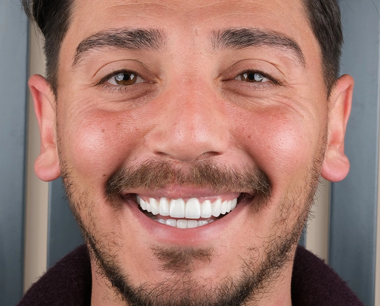 Emax veneer before and after