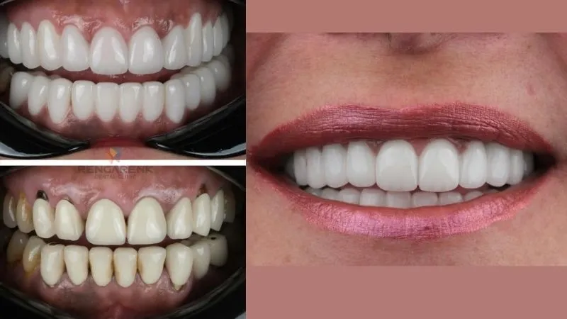 Emax veneers Antalya Emax veneers Antalya
