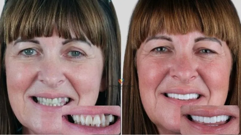 Emax veneers Turkey Emax veneers Turkey